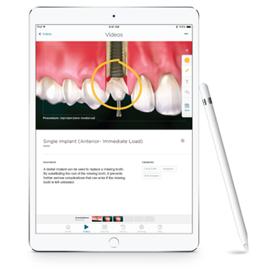 Updates in Direct Restorative