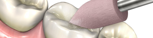 Updates in Direct Restorative